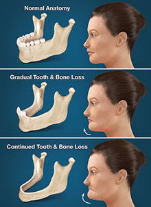 Example of bone loss